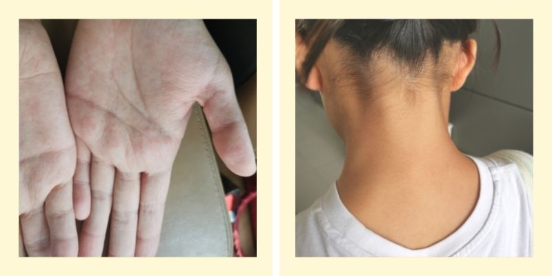eczema-skin-after.jpg