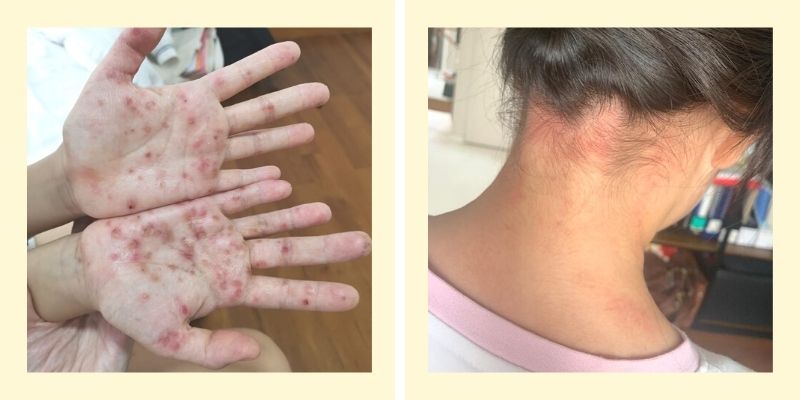 eczema-skin-before.jpg